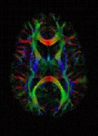 Diffusion tensor imaging
